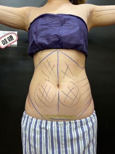 腰腹环吸两个月了 现在已经稳定的差不多了.