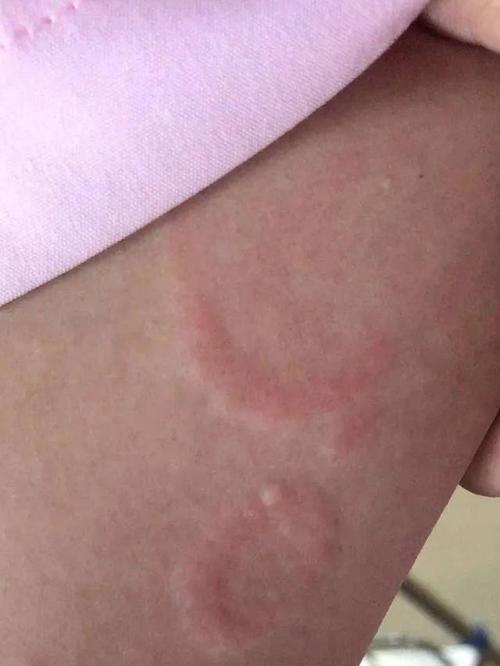 常见面部皮肤病科普:面癣