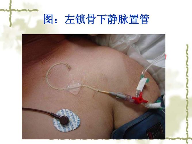 左锁骨下静脉置管