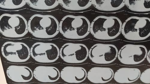 肺泡灌洗对大叶性肺炎的辅助治疗