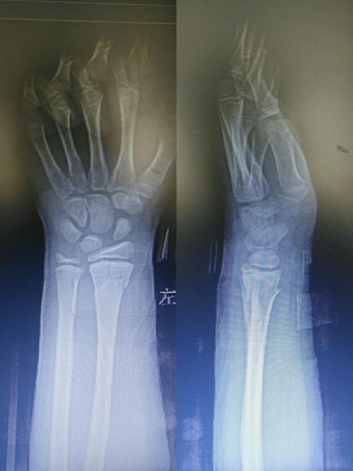 复位后拍片:左桡骨远端骨折,对位对线良好.