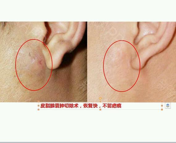 原以为只是淋巴发炎,去医院检查后才知道是皮脂腺囊肿.