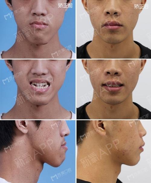 治疗前18岁的男生,由于"地包天,大下巴"前来寻求治疗.