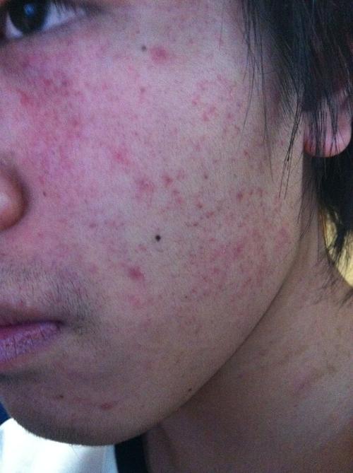 脸上长红点点怎么办