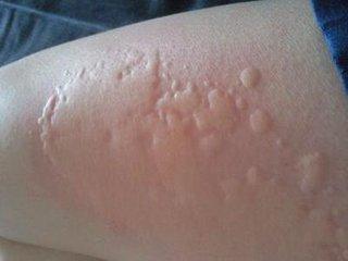 冬季应如何预防皮肤过敏