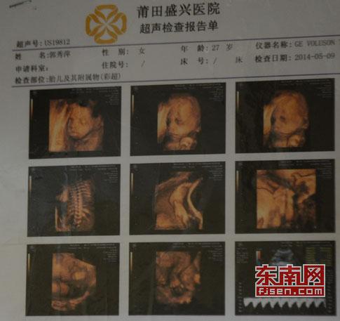 胎儿彩超报告单