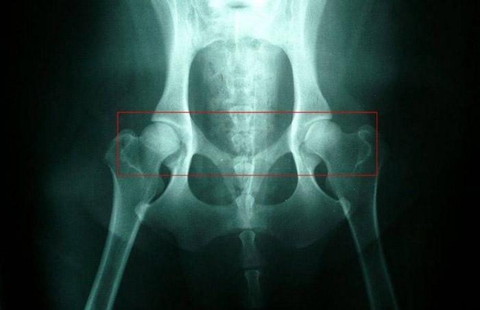 这是正常的髋关节x光片