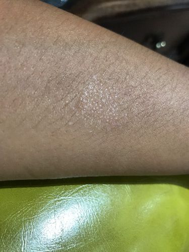 这是皮肤癣吗?不痛不痒,但持续好几个月了,也没有扩散