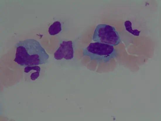 按照惯例,遇到这种患者我们就是涂片镜检,人工计数.