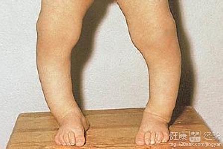 维生素d依赖性佝偻病如何诊断鉴别