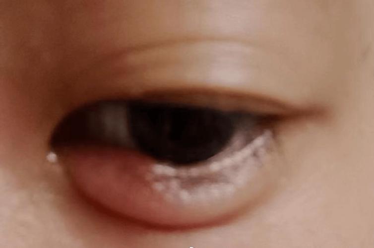 1 眼睛上长脓包——"针眼" 针眼又叫做麦粒肿,是眼科临床非常常见的