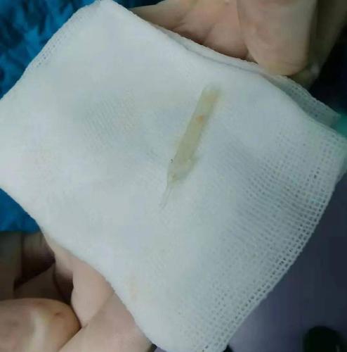 2019年曾在当地行"左眼鼻泪管植入术",术后鼻泪管未拔出