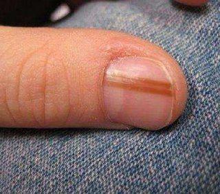 在外形上有很多相似之处,很容易混淆,而且甲母痣还很容易癌变为黑色素