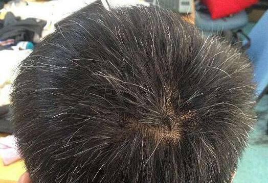 后脑勺对应的反射区是膀胱经.膀胱经虚弱的人,常伴