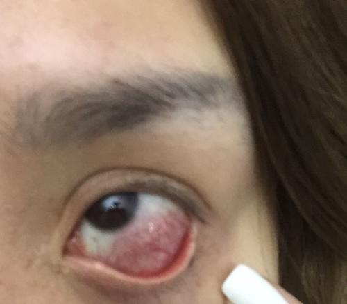 然后发炎过敏了.马上卸掉了 昨天接的 后来用了点眼药水 和药膏.