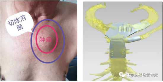 病例5:胸骨肿瘤胸锁关节切除重建