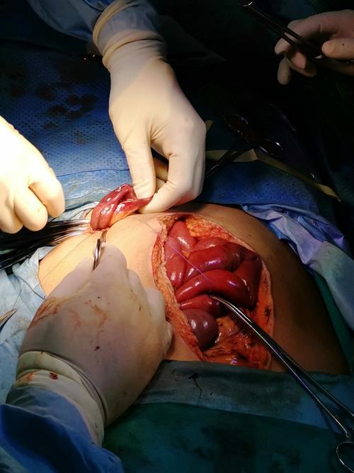 团队急症手术,成功救治1例主动脉夹层并发肠缺血和胃穿孔的危重患者