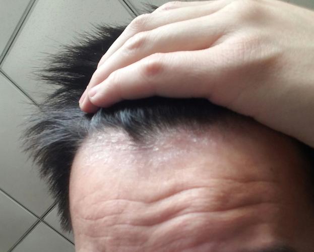 每次洗完头,发际线周围都很干,有白色鳞屑,如图,什么原因