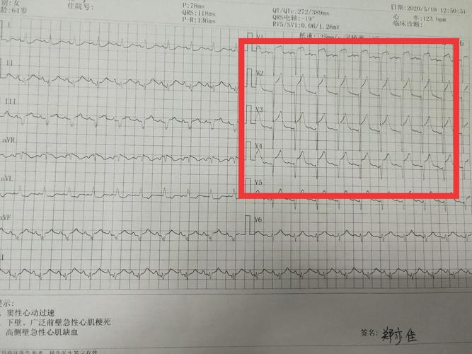 复查心电图结果回示:下壁,广泛前壁,右室急性心肌梗死,立即给予生理