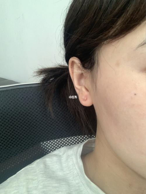 耳洞疤痕疙瘩想手术了_耳洞_疤痕_疤痕疙瘩_医疗健康