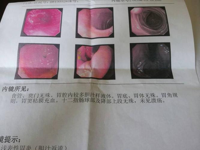 贲门结构正常.胃底粘.