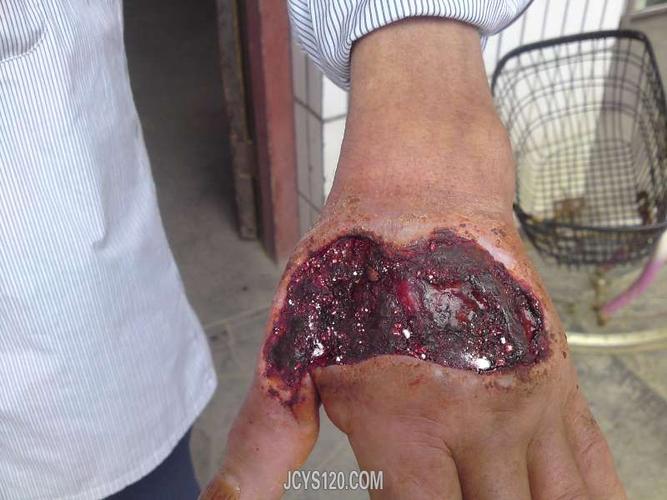 眼镜蛇咬伤后溃疡治验1例