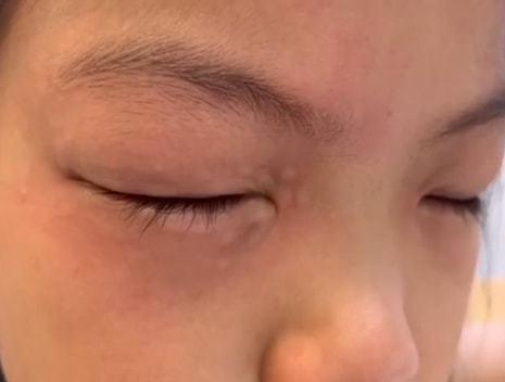 9岁小学生得怪症,一做数学题眼睛就过敏,数学老师不背