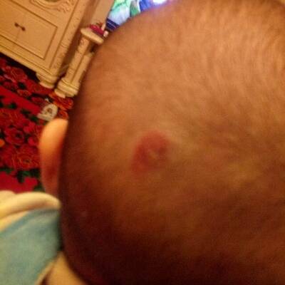 宝宝头上长了个东西,流黄水,慢慢变大