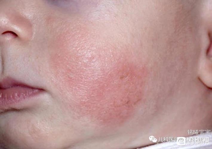 痱子和湿疹这次一定能分清楚了
