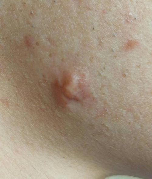 痘疤一年不消变硬如何治疗费用贵吗?