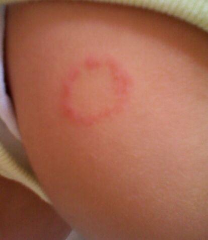 宝宝脖子和大腿根部长了类似这样的红块,是湿疹吗?还是癣?如何治疗?