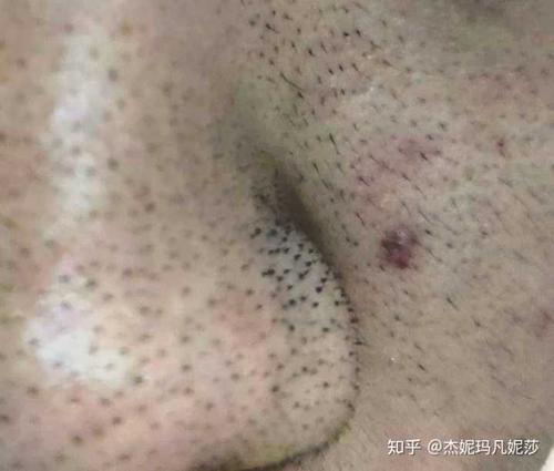 怎么很好的去鼻子黑头?