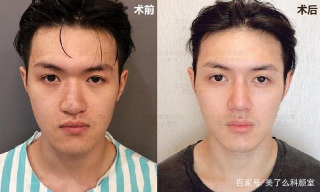 凹陷比较明显,从侧面看会发现,脸型中间的部分是低下去的,所以嘴巴