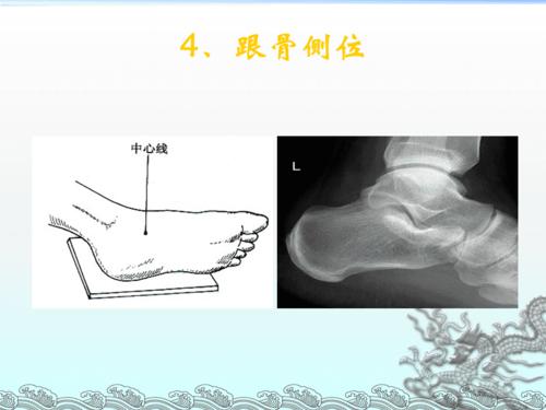 跟骨普通x线摄影