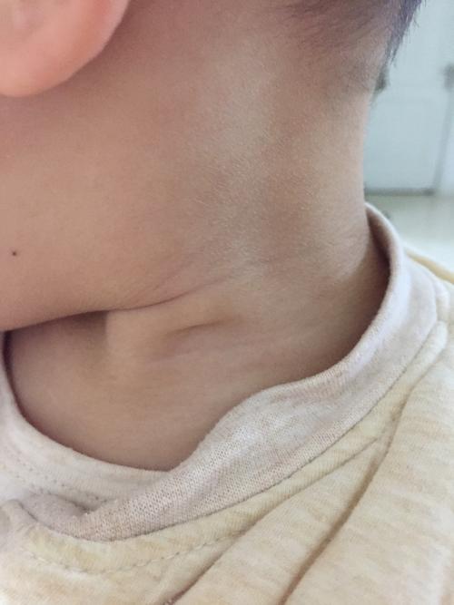 宝宝颈部有个凹陷的小眼是瘘管吗