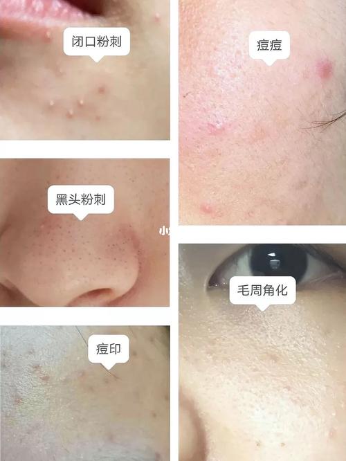 脸上的粉刺闭口痘痘都没了_痘肌_痘痘_粉刺_闭口痘痘_祛痘_科颜氏怎么