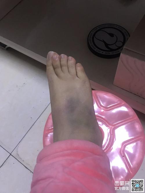 通往吴家这条路的路灯坏了,摔了一跤现在脚都还是淤青