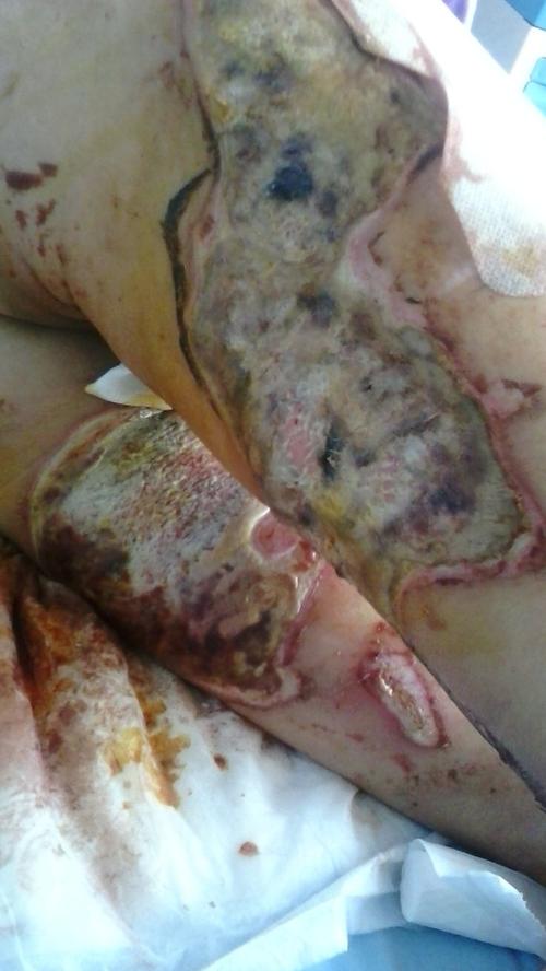 电刀手术伤口图片