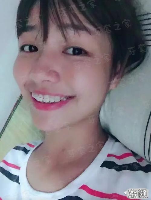 门牙突被叫"兔牙妹",没拔牙矫正,这钱没白花