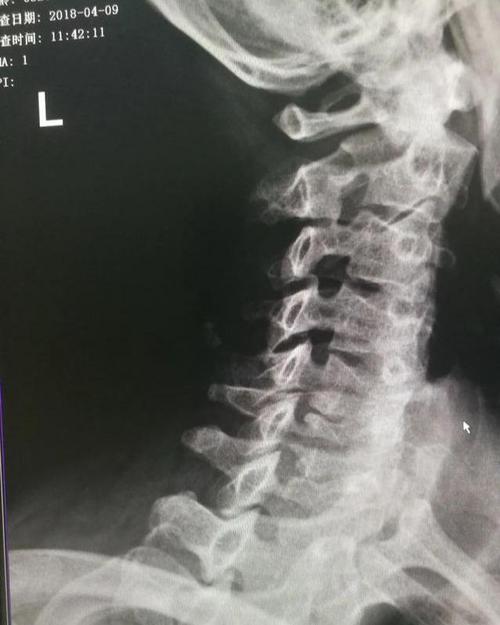 神经根型颈椎病自然病程及发展:一个神经根型颈椎病患者的自述