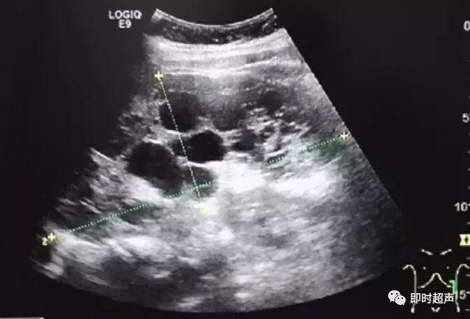 彩超:脾脏增大,大小约172mm×77mm,形态失常,正常脾脏实质消失,内见