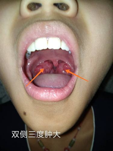 微创根治扁桃体炎 写美篇故而具有微创无痛去除病灶,保留了扁桃体正常