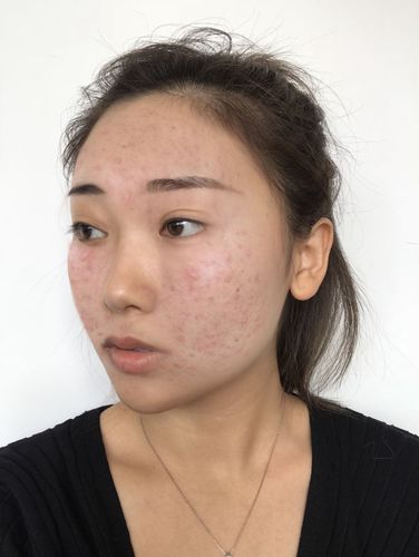 痘痘 痘印 项目分类:皮肤管理 点阵激光 去痘印痘坑