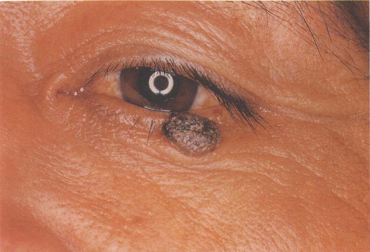 眼睑色素痣的图片