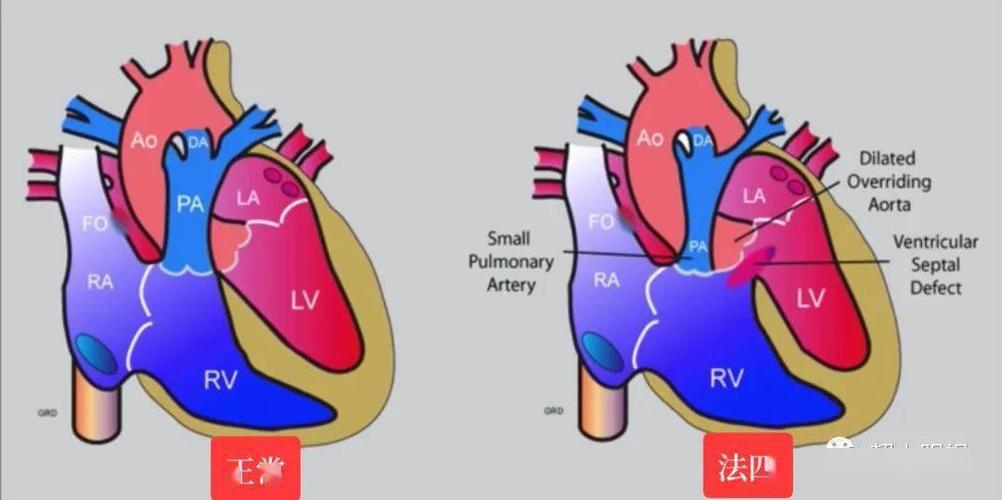 右为法四:室缺,主动脉骑跨,肺动脉狭窄法四的四腔观往往看起来正常!