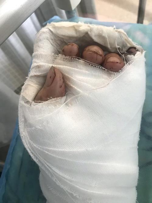 多次有效地完成手足外科断肢(趾,指)再植,挽救了大量濒临截肢,断肢的