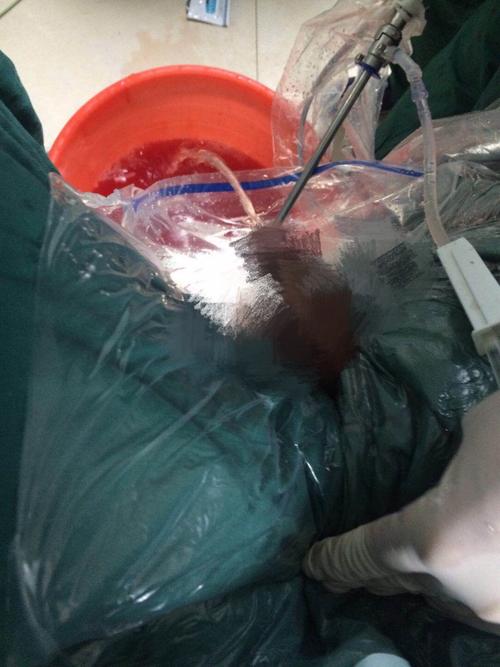 尿道钬激光前列腺解剖性剜除手术 写美篇  前列腺增生症是老年男性