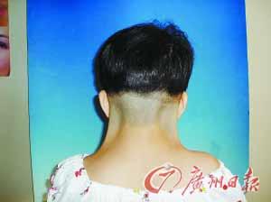 关注·热点   专家介绍,"蹼颈"多发于女性,主要原因是染色体变异.