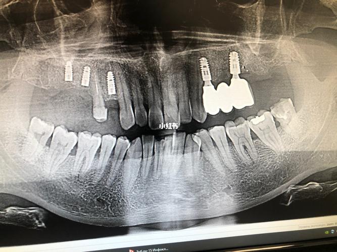 帮忙看看刚种的三颗是否歪了,感谢!_种植牙_医疗健康