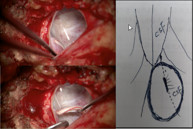 陈来照主任团队:骶管囊肿一例